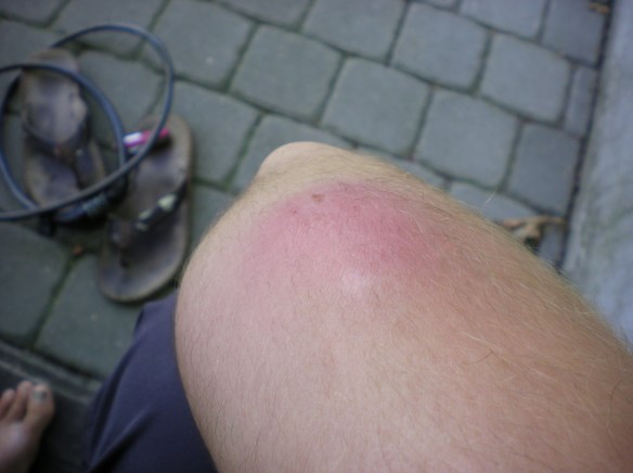 This thing hurts! Showed up one day and continued to grow 