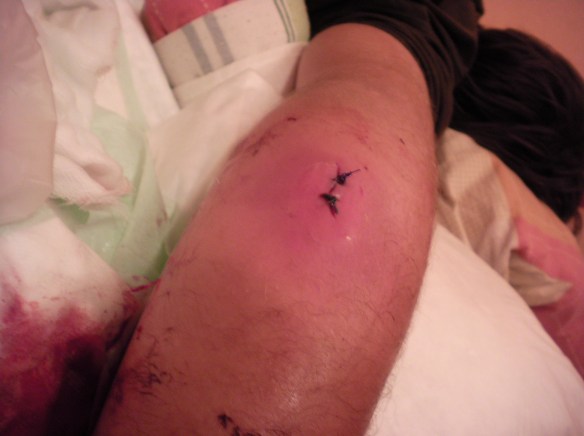 Just after the procedure